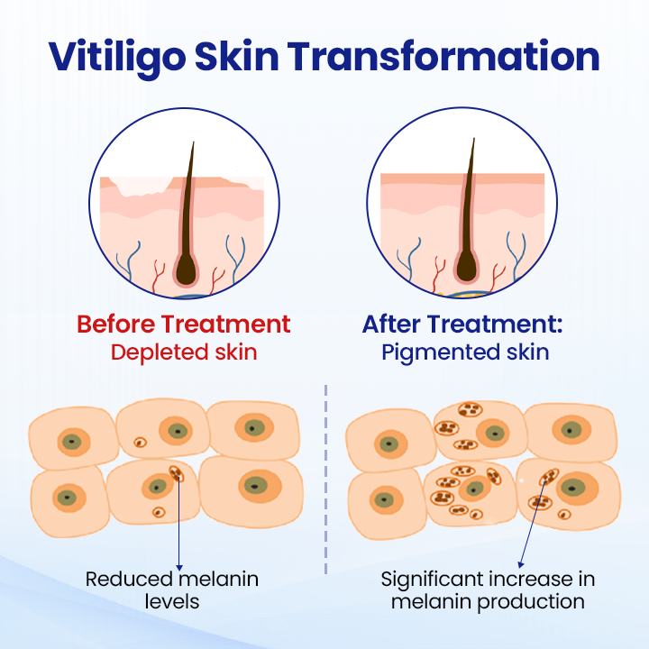 Lovilds® Vitiligo Treatment Spray